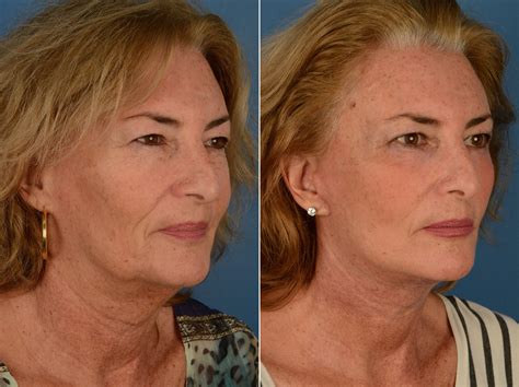 The Uplift™ Lower Face And Neck Lift Photos Naples Fl Patient 12782