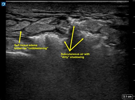 Sonographic Crepitus A Point Of Care Ultrasound Finding Pocus Journal