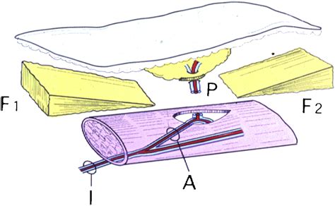 Perforator Flaps And Supermicrosurgery Clinics In Plastic Surgery