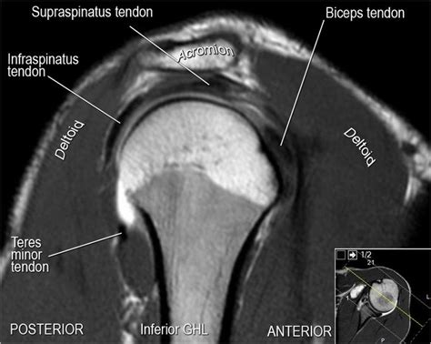Injuries to the biceps tendons include: Related image | Shoulder anatomy, Tendon tear ...