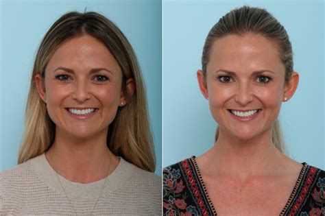 Botox Cosmetic Before And After Photo Gallery