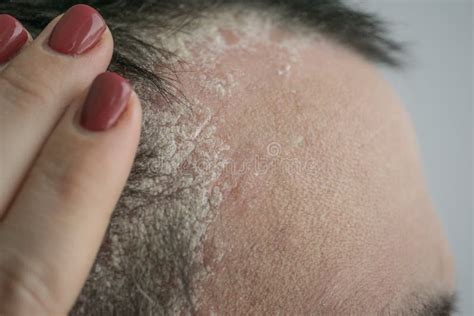 Psoriasis On The Hairline And On The Scalp Close Up Dermatological