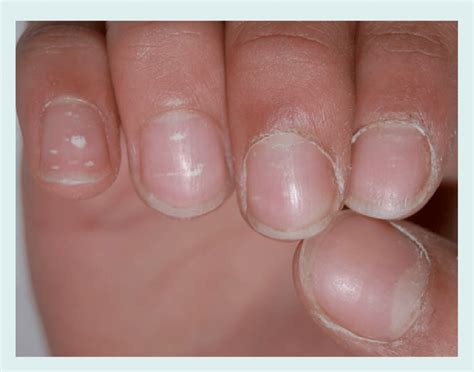 Punctate Leukonychia In The Fingernails Of An 8 Year Old Boy Small