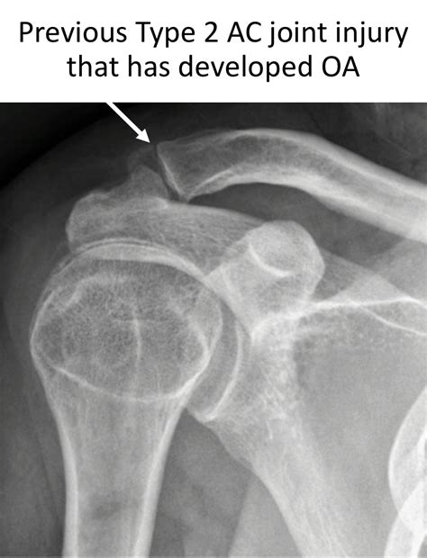 Acromioclavicular Jt Acjt Cambridge Shoulder