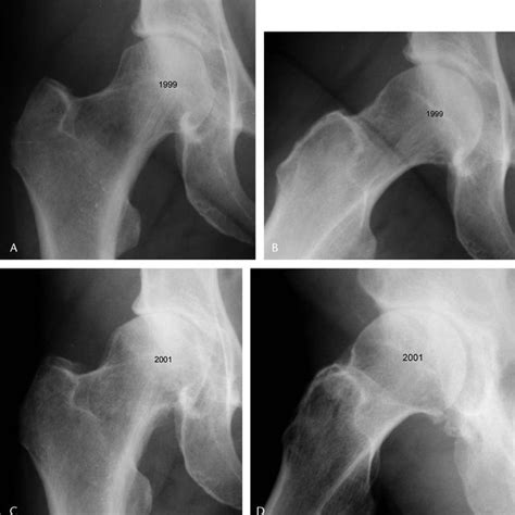 A A Pistol Grip Deformity On The Anteroposterior Radiograph Of A