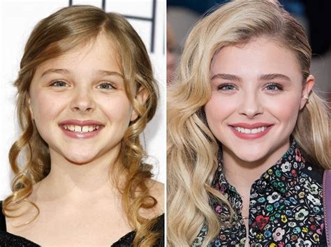 Chloë Grace Moretz Before And After Plastic Surgery Nose Face Teeth