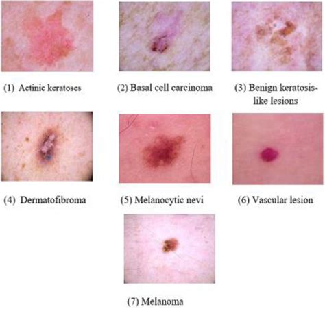 Characteristics Of Benign Skin Lesions Skin Lesions What S The