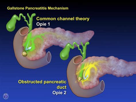 Acute Pancreatitis Bench To The Bedside Gastroenterology