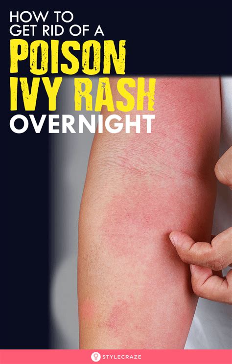 How To Get Rid Of A Poison Ivy Rash Overnight In 2020 With Images