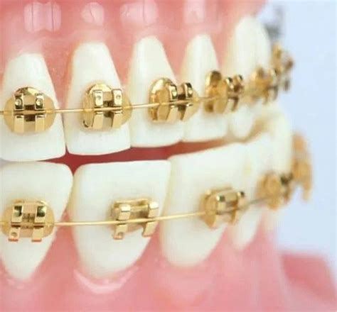 Gold Braces Aesthetic Braces In Narellan Harris Orthodontics