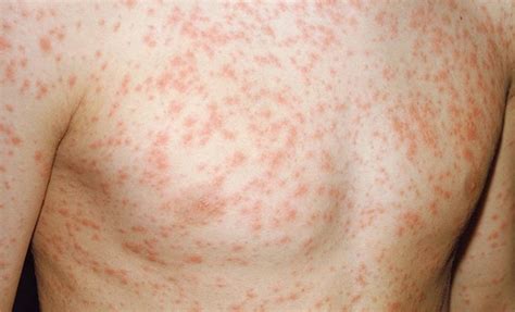 13 Causes Of Non Itchy Rash