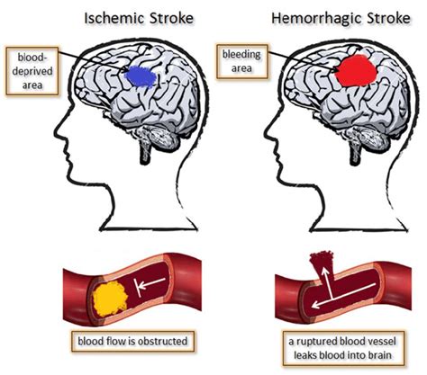 Stroke Types Ischemic Versus Hemorrhagic