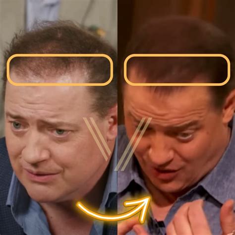 Brendan Frasers Hair Transplant Before And After Transformation