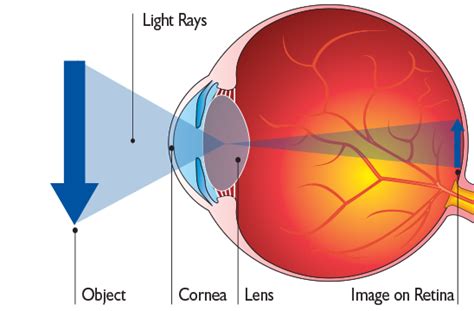 Cataract Eye Surgery Rand Eye Institute