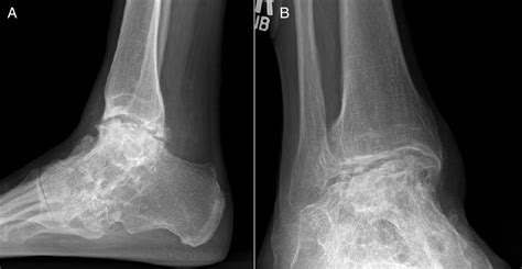 Tibiocalcaneal Arthrodesis With A Porous Tantalum Spacer And Locked