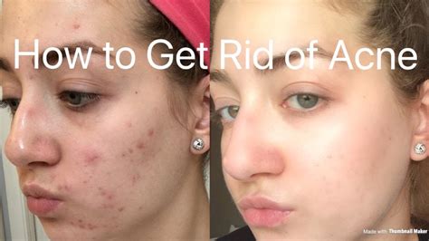 HOW TO GET RID OF ACNE | SKINCARE ROUTINE AND JOURNEY | HDMakeuupp