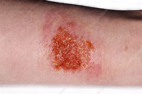 Infected Burn Stock Image C0284384 Science Photo Library