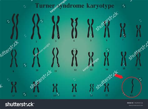 Karyotype Turner Syndrome Ts Known X Stock Vector Royalty Free