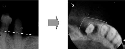 A Periapical Radiograph Showing Angular Bone Defects In 34 B