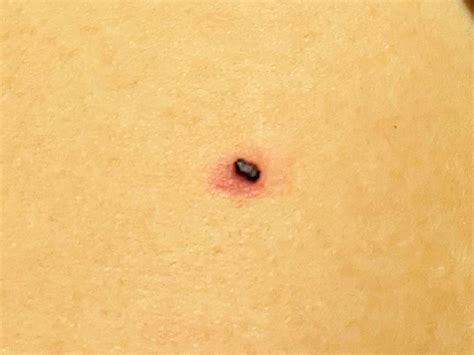 9 Best Rskincancer Images On Pholder Good Day All This Red Sore