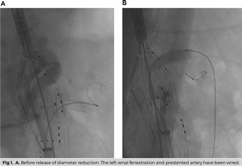 Figure 1 From Balloon Guidance For Superior Mesenteric Artery Scallop