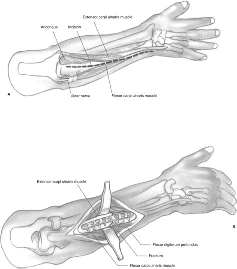 Forearm Diaphyseal Fractures Musculoskeletal Key