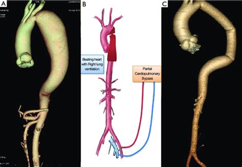 Coa With Descending Thoracic Aorta Aneurysm In A 36 Year Old Male Case