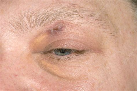 Healing Eyelid Abscess Stock Image M1080799 Science Photo Library