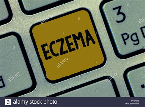 Text Sign Showing Eczema Conceptual Photo Skin Condition Marked By