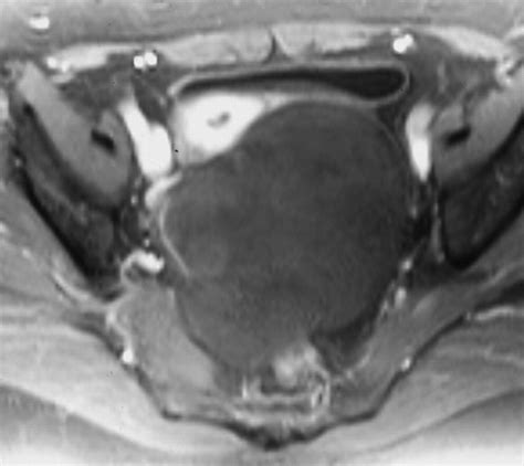 Ct And Mri Findings Of Sex Cordstromal Tumor Of The Ovary Ajr