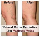 Images of Leg Vein Covering Makeup