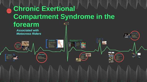 Chronic Exertional Compartment Syndrome By Crystal Loveland