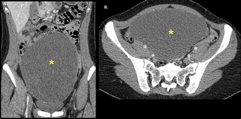 Mucinous Cystadenoma In A 26 Year Old Woman Ct Coronal A And Axial