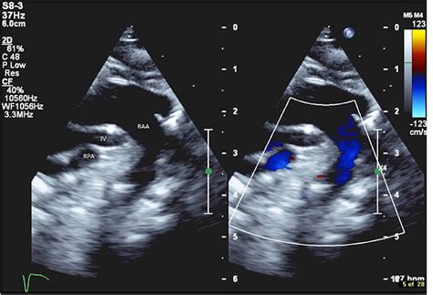 Right Aortic Arch Ultrasound