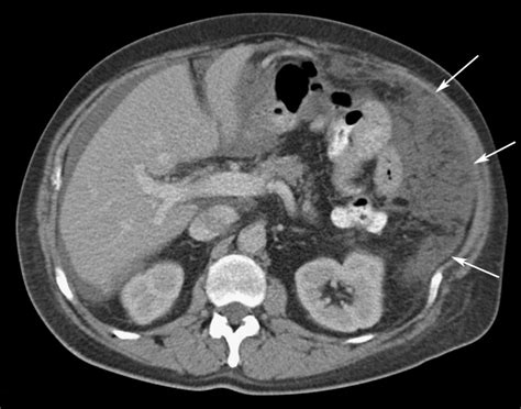 Colon Cancer In A 65 Year Old Man Ct Image Demonstrates A Thick