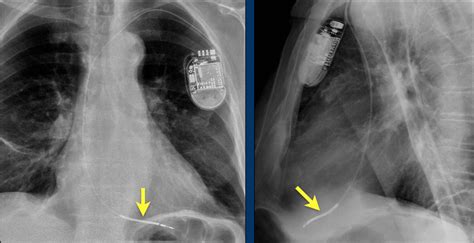 The Radiology Assistant Cardiovascular Devices