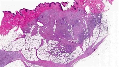 Dermatofibrosarcoma Protuberans Histology