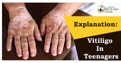 Vitiligo Phulwari Treatment In India Punjab Jalandhar Safed Daag