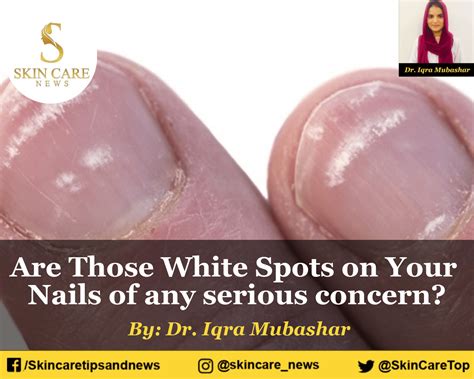 Are Those White Spots On Your Nails Of Any Serious Concern