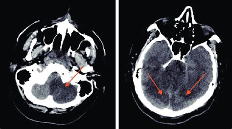 Ct Image Of Acute Infarct In Cerebellum And Occipital Lobe Ct