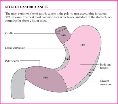 Most Common Site For Gastric Cancer Cancerwalls