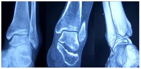 A Fracture Of The Lateral Malleolus Can Be Clearly Seen Download