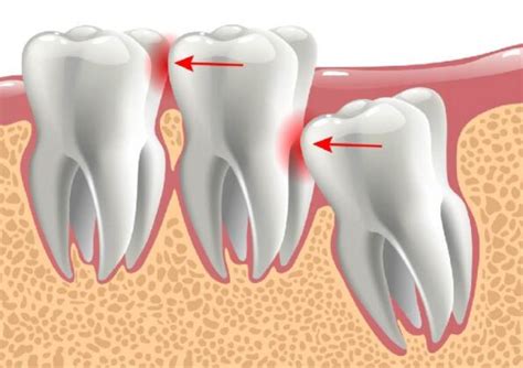 Why Does My Throat Hurts After Wisdom Tooth Removal Health Blog