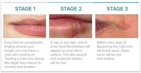 Canker sores are not contagious. What Does A Herpe Sore Look Like In The Mouth ~ news word