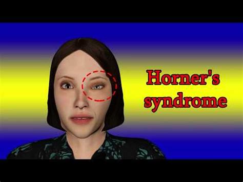 Horner S Syndrome Symptoms And Causes Youtube