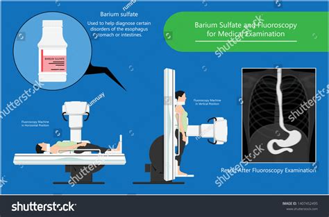 Barium Swallow Study Test Diagnose Barrett S GI Royalty Free Stock