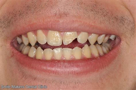 The roots of teeth are covered by gums. Smile Makers | How to Restore Chipped or Broken Teeth
