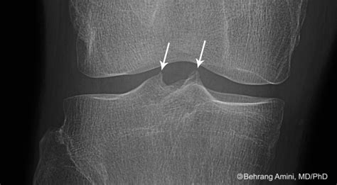 Roentgen Ray Reader Intercondylar Spine Spiking And Osteoarthritis