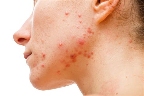 Types Of Acne And How To Treat Them