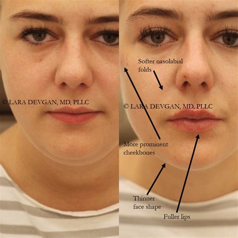 Cheekbone And Lip Filler To Rejuvenate The Face — Lara Devgan Md Mph